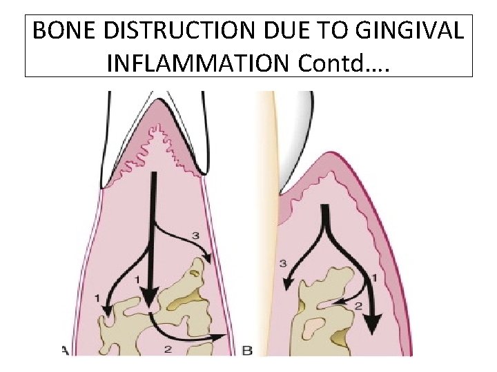 BONE DISTRUCTION DUE TO GINGIVAL INFLAMMATION Contd…. 