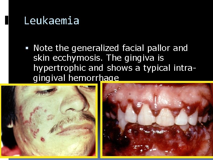 Leukaemia Note the generalized facial pallor and skin ecchymosis. The gingiva is hypertrophic and