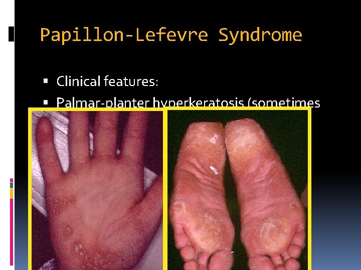 Papillon-Lefevre Syndrome Clinical features: Palmar-planter hyperkeratosis (sometimes knees and elbows) Severe periodontal disease Calcification