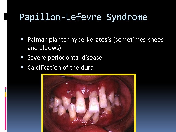 Papillon-Lefevre Syndrome Palmar-planter hyperkeratosis (sometimes knees and elbows) Severe periodontal disease Calcification of the