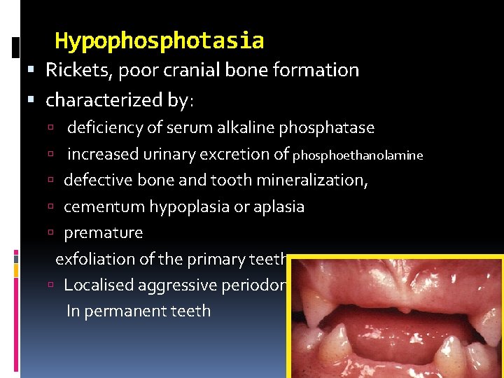 Hypophosphotasia Rickets, poor cranial bone formation characterized by: deficiency of serum alkaline phosphatase increased