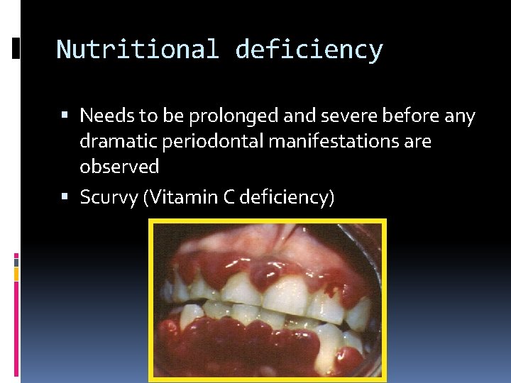Nutritional deficiency Needs to be prolonged and severe before any dramatic periodontal manifestations are