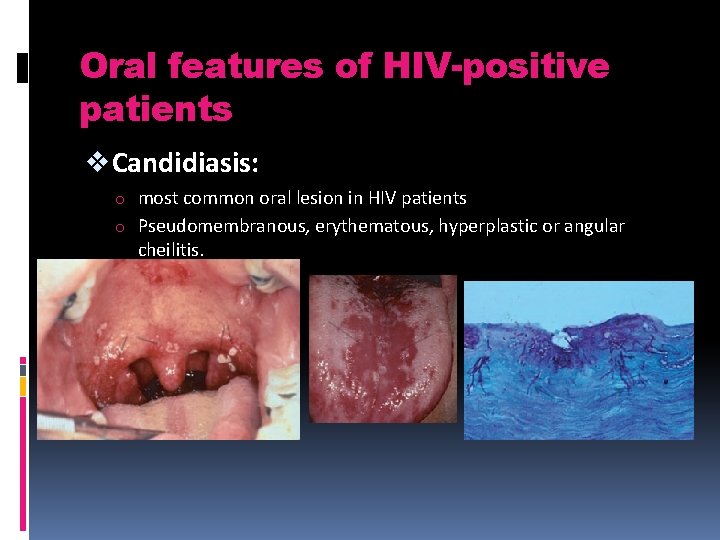 Oral features of HIV-positive patients v Candidiasis: o most common oral lesion in HIV