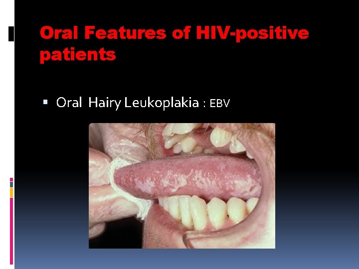 Oral Features of HIV-positive patients Oral Hairy Leukoplakia : EBV 