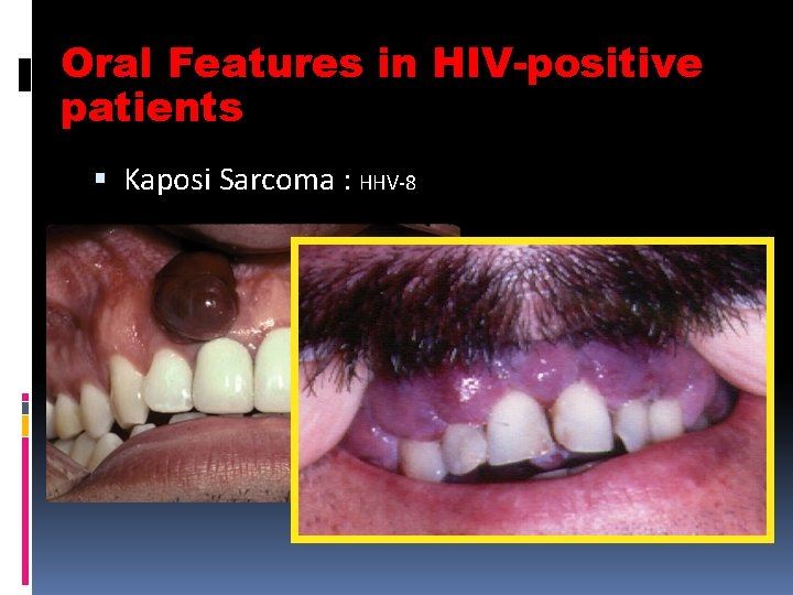 Oral Features in HIV-positive patients Kaposi Sarcoma : HHV-8 