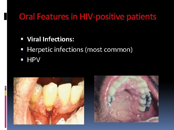 Oral Features in HIV-positive patients Viral Infections: Herpetic infections (most common) HPV 