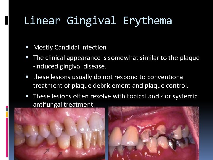Linear Gingival Erythema Mostly Candidal infection The clinical appearance is somewhat similar to the
