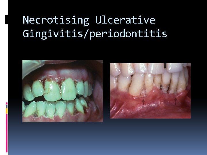 Necrotising Ulcerative Gingivitis/periodontitis 