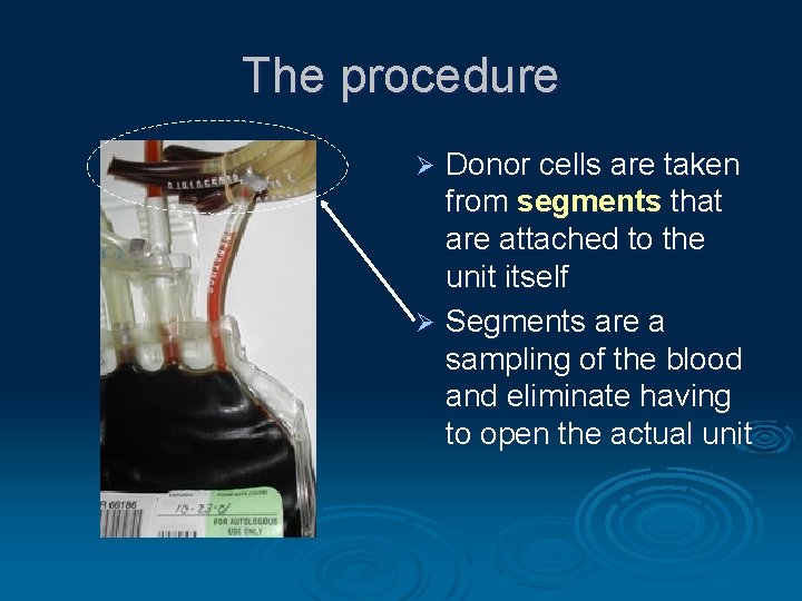 The procedure Donor cells are taken from segments that are attached to the unit