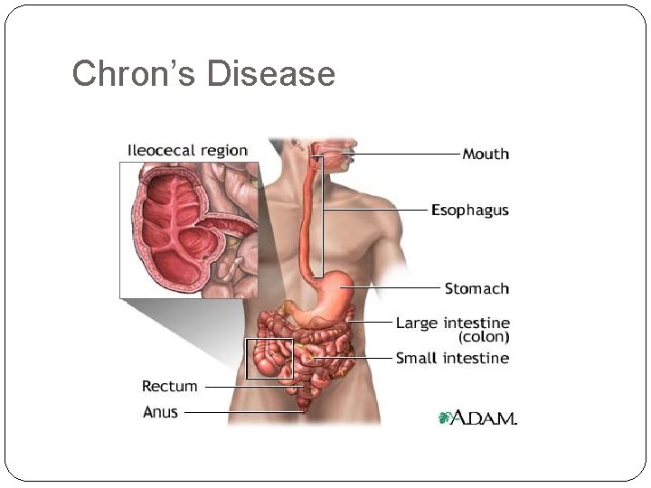 Chron’s Disease 