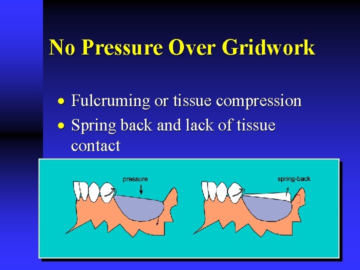 No Pressure Over Gridwork · Fulcruming or tissue compression · Spring back and lack