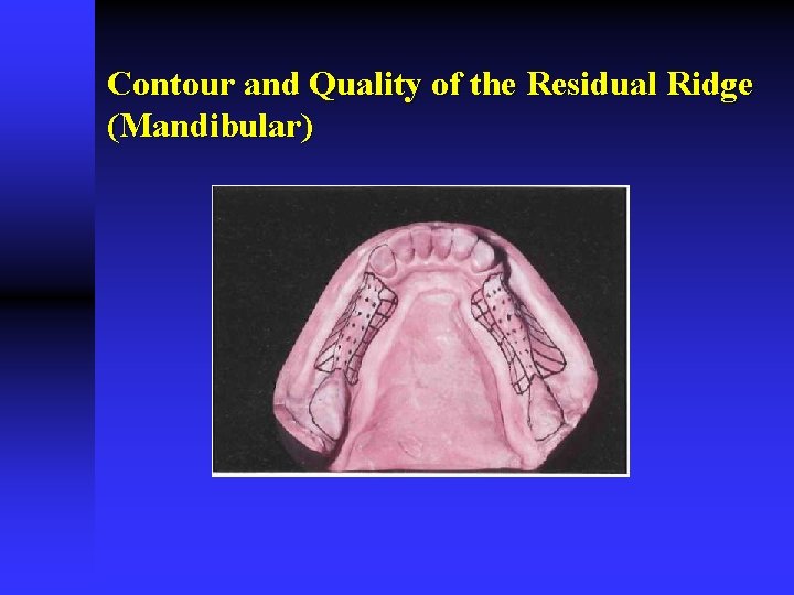 Contour and Quality of the Residual Ridge (Mandibular) 