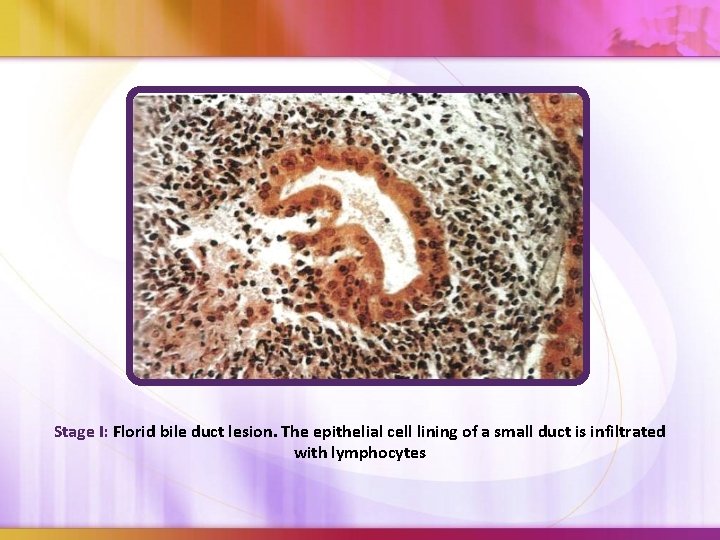 Stage I: Florid bile duct lesion. The epithelial cell lining of a small duct