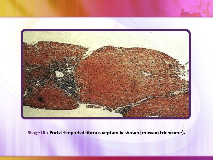 Stage III : Portal-to-portal fibrous septum is shown (masson trichrome). 