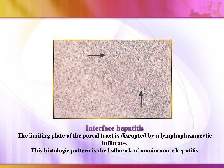 Interface hepatitis The limiting plate of the portal tract is disrupted by a lymphoplasmacytic