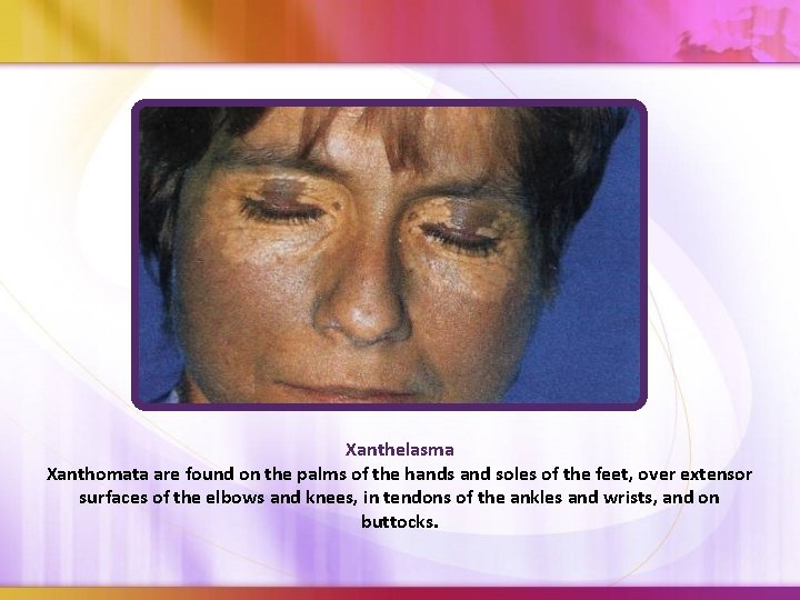 Xanthelasma Xanthomata are found on the palms of the hands and soles of the