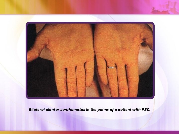 Bilateral plantar xanthomatas in the palms of a patient with PBC. 