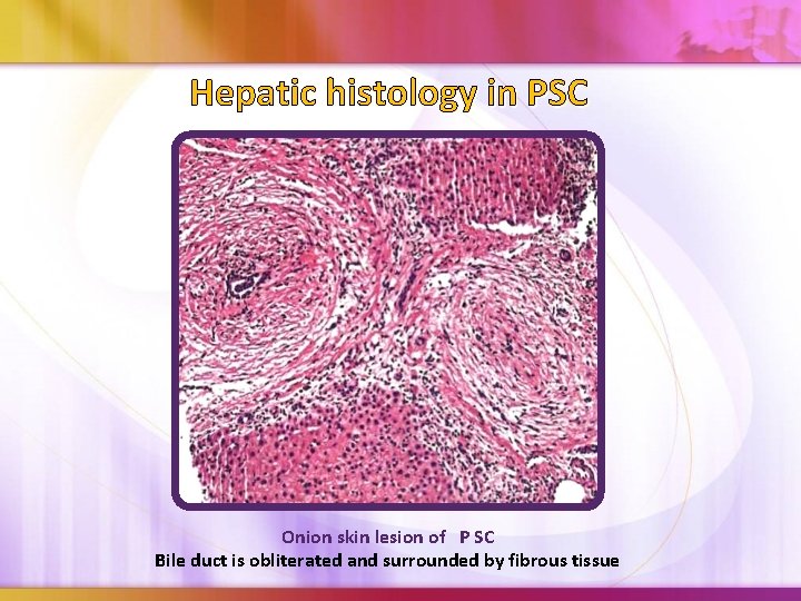 Hepatic histology in PSC Onion skin lesion of P SC Bile duct is obliterated