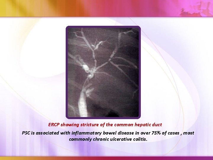 ERCP showing stricture of the common hepatic duct PSC is associated with inflammatory bowel