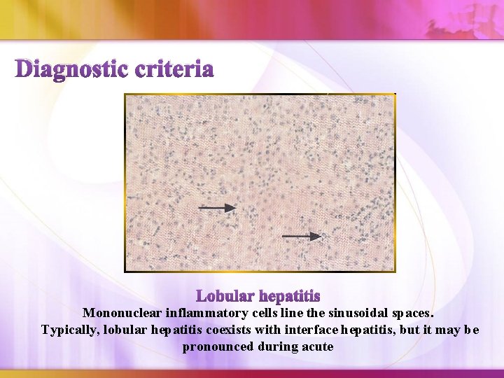 Diagnostic criteria Lobular hepatitis Mononuclear inflammatory cells line the sinusoidal spaces. Typically, lobular hepatitis