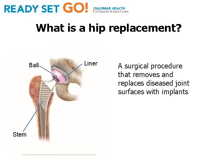 What is a hip replacement? Ball Stem Liner A surgical procedure that removes and