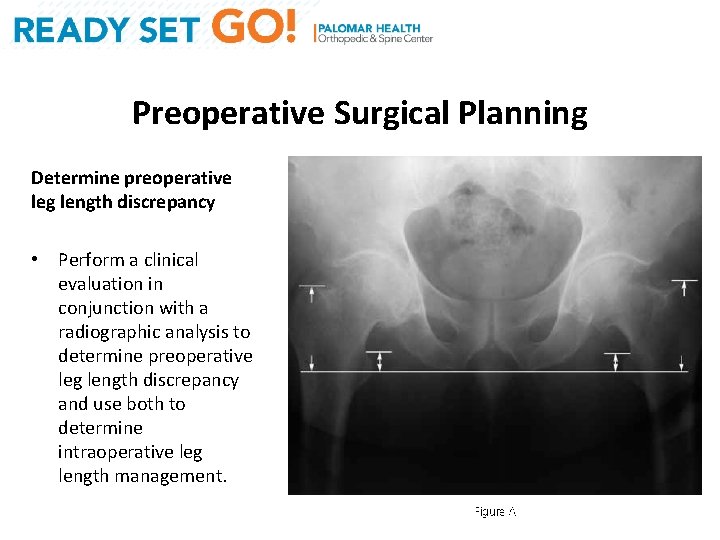 Preoperative Surgical Planning Determine preoperative leg length discrepancy • Perform a clinical evaluation in