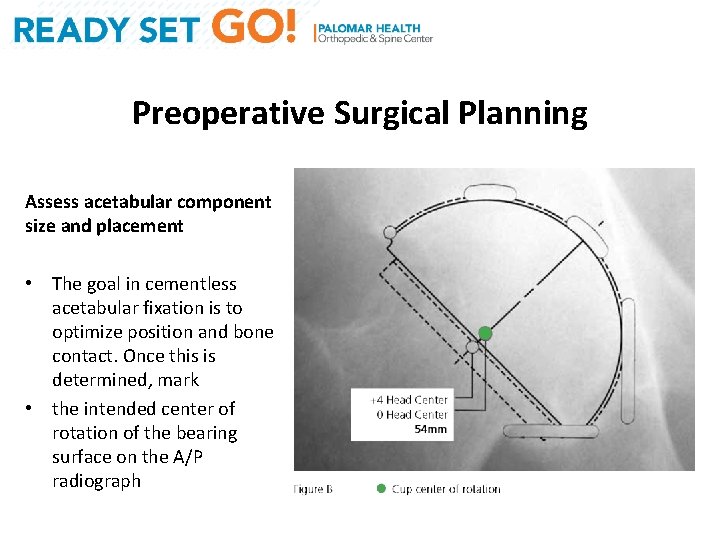 Preoperative Surgical Planning Assess acetabular component size and placement • The goal in cementless