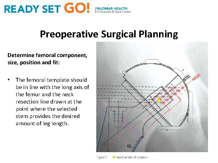 Preoperative Surgical Planning Determine femoral component, size, position and fit: • The femoral template