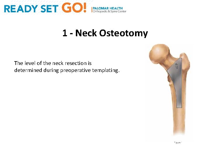 1 - Neck Osteotomy The level of the neck resection is determined during preoperative