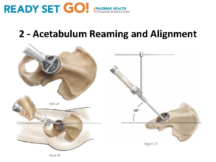 2 - Acetabulum Reaming and Alignment 