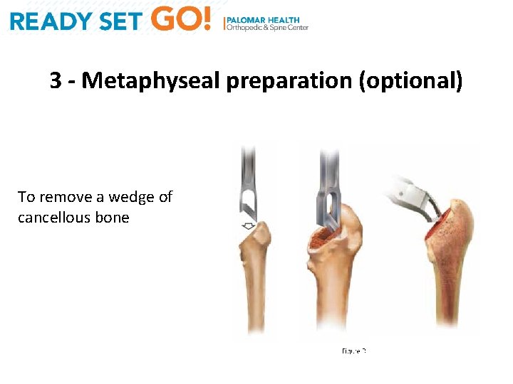 3 - Metaphyseal preparation (optional) To remove a wedge of cancellous bone 