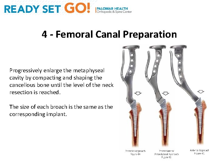 4 - Femoral Canal Preparation Progressively enlarge the metaphyseal cavity by compacting and shaping