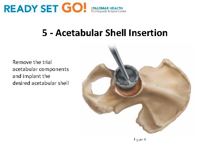 5 - Acetabular Shell Insertion Remove the trial acetabular components and implant the desired