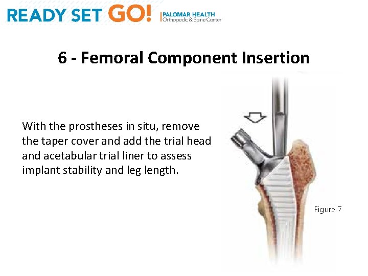 6 - Femoral Component Insertion With the prostheses in situ, remove the taper cover