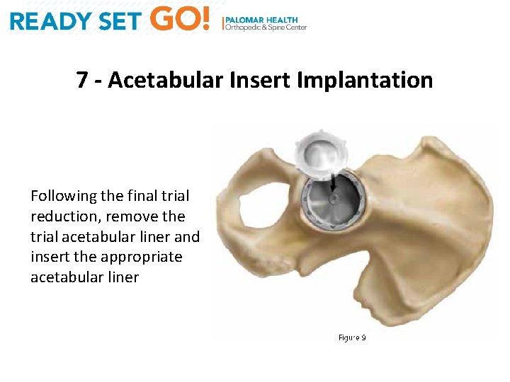 7 - Acetabular Insert Implantation Following the final trial reduction, remove the trial acetabular