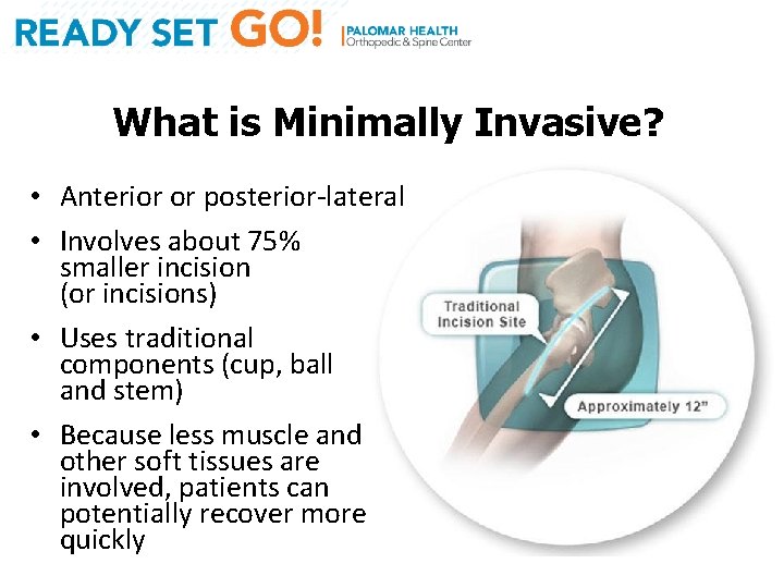 What is Minimally Invasive? • Anterior or posterior-lateral • Involves about 75% smaller incision