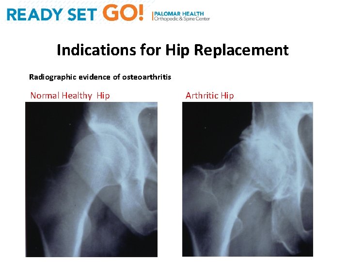 Indications for Hip Replacement Radiographic evidence of osteoarthritis Normal Healthy Hip Arthritic Hip 