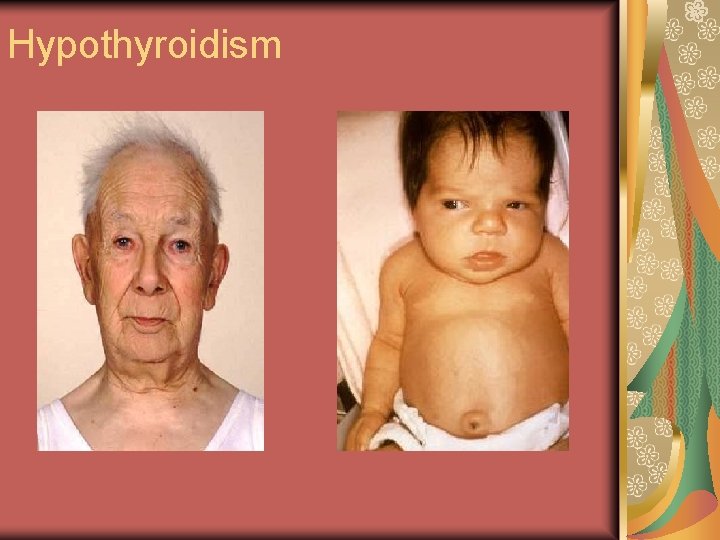 Hypothyroidism 