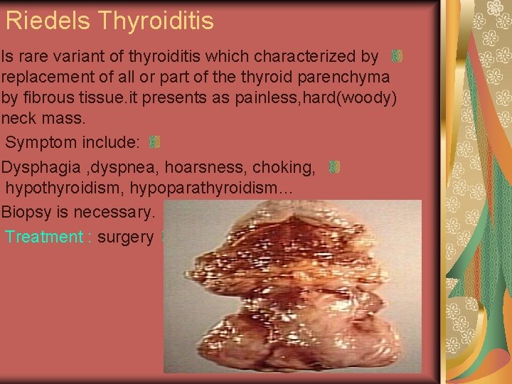 Riedels Thyroiditis Is rare variant of thyroiditis which characterized by replacement of all or