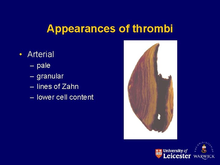 Appearances of thrombi • Arterial – – pale granular lines of Zahn lower cell