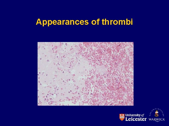 Appearances of thrombi 