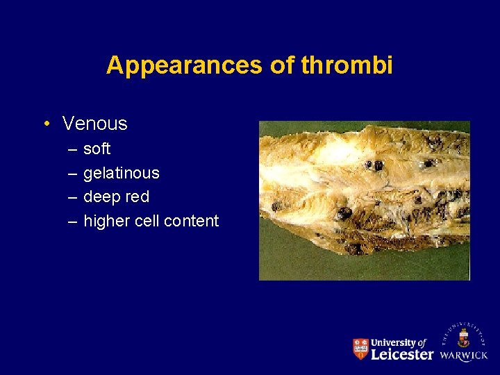 Appearances of thrombi • Venous – – soft gelatinous deep red higher cell content