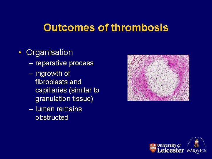 Outcomes of thrombosis • Organisation – reparative process – ingrowth of fibroblasts and capillaries