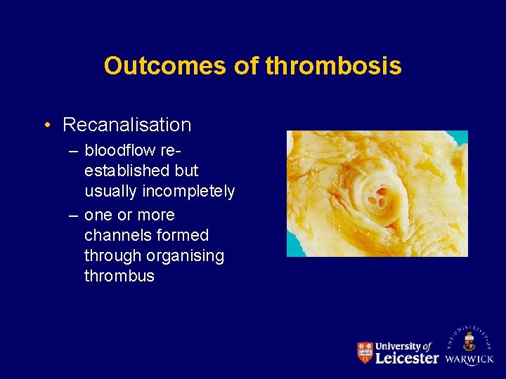 Outcomes of thrombosis • Recanalisation – bloodflow reestablished but usually incompletely – one or