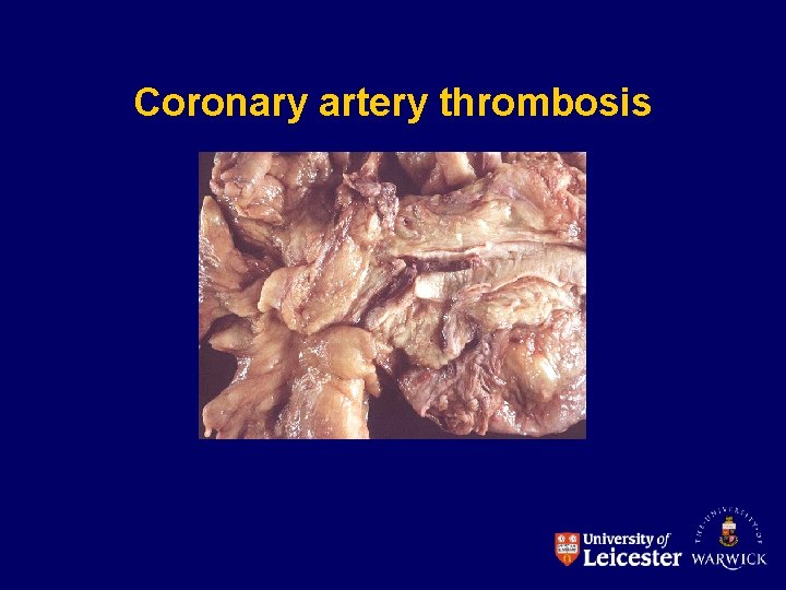 Coronary artery thrombosis 