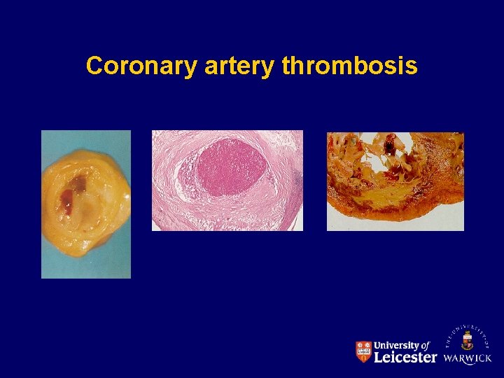 Coronary artery thrombosis 