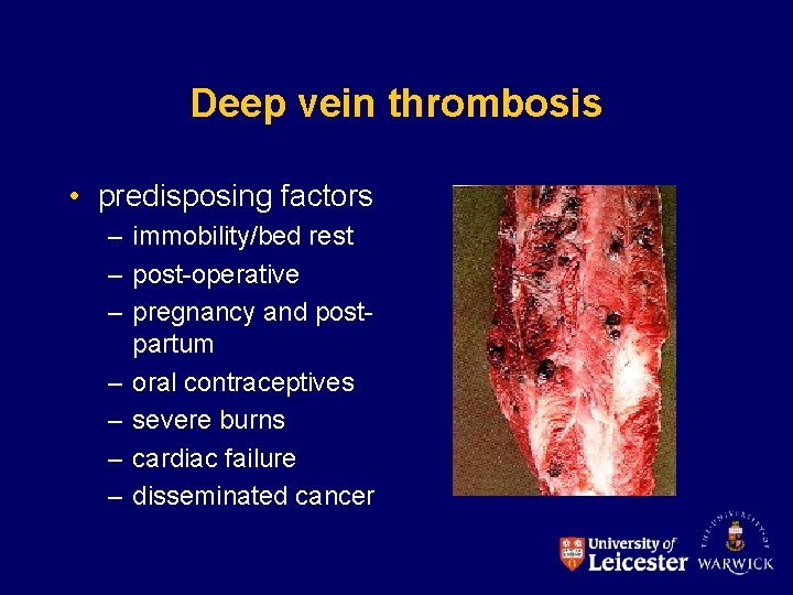 Deep vein thrombosis • predisposing factors – immobility/bed rest – post-operative – pregnancy and