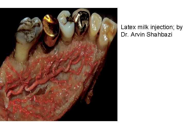 Latex milk injection; by Dr. Arvin Shahbazi 
