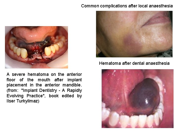 Common complications after local anaesthesia Hematoma after dental anaesthesia A severe hematoma on the