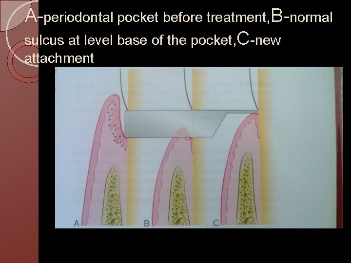 A-periodontal pocket before treatment, B-normal sulcus at level base of the pocket, C-new attachment